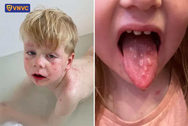 mụn nước do trái rạ ở mắt và miệng