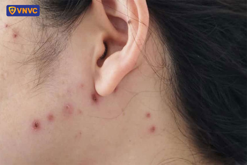 mụn nước thuỷ đậu ở sau gáy