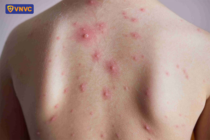 mụn ở trên lưng do thuỷ đậu