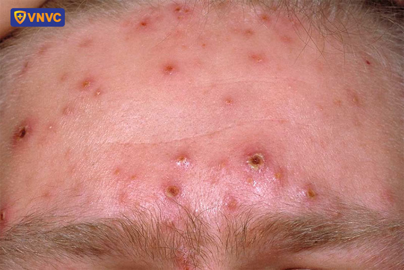 mụn thuỷ đậu ở trên trán