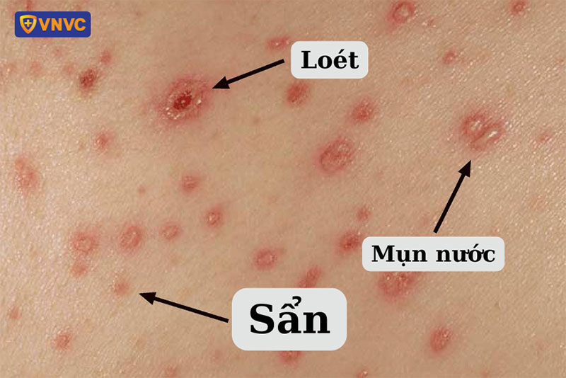 các nốt ban do bệnh trái rạ