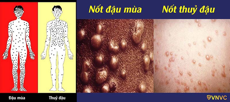 nốt thủy đậu và đậu mùa