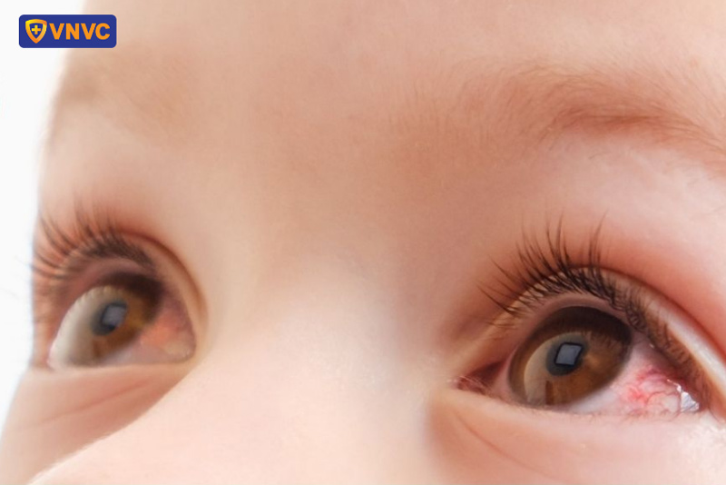 sốt xuất huyết bị đỏ mắt