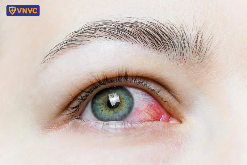 sốt xuất huyết có bị đỏ mắt không