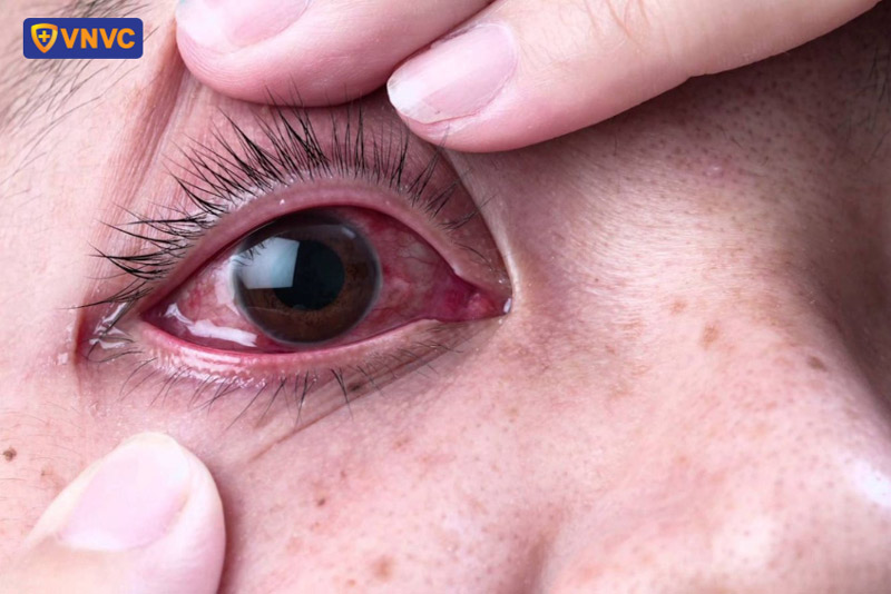 sốt xuất huyết đỏ mắt