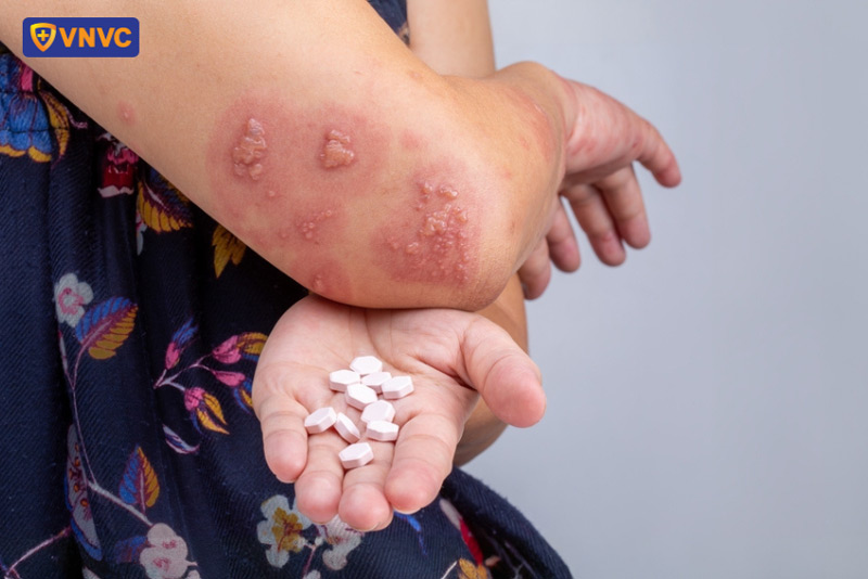 thuốc điều trị giời leo