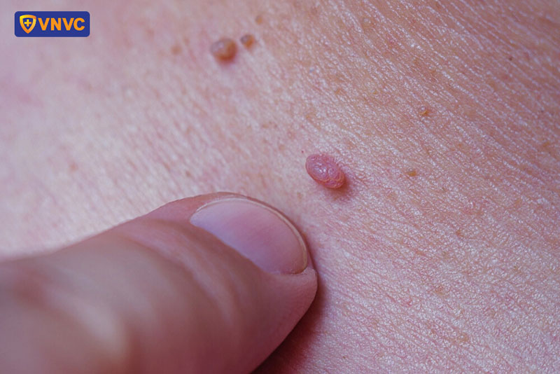 tiêm hpv bảo vệ sức khoẻ cho nam giới
