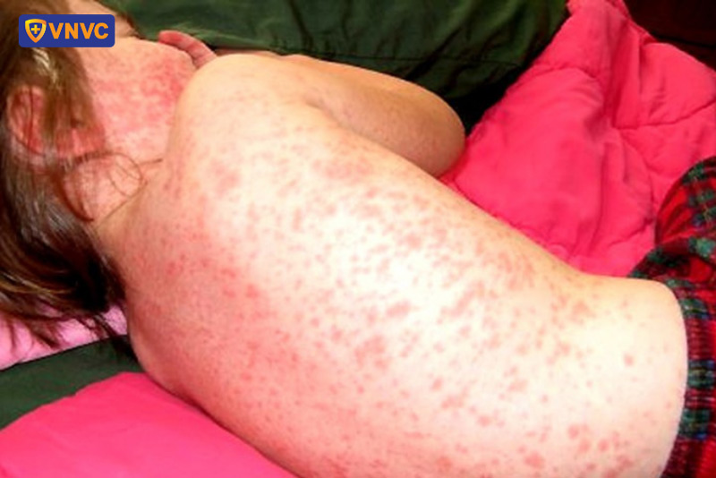 trẻ bị sốt xuất huyết có cần nhập viện không