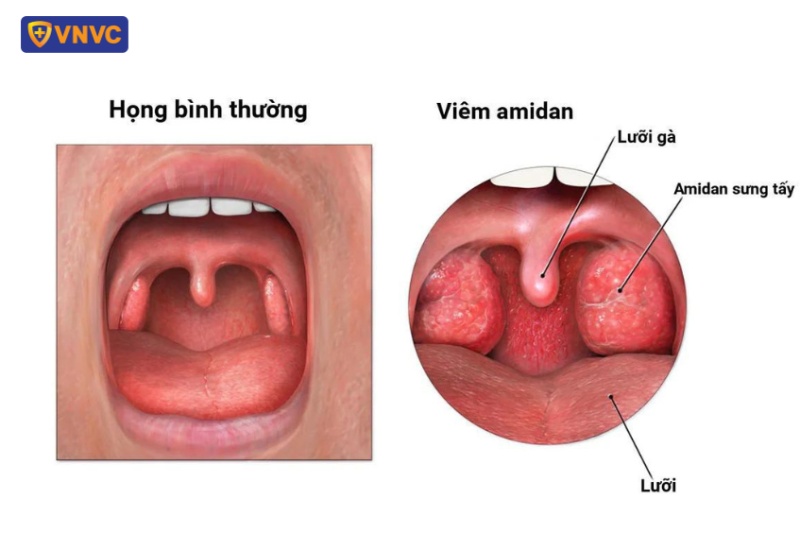 Viêm amidan