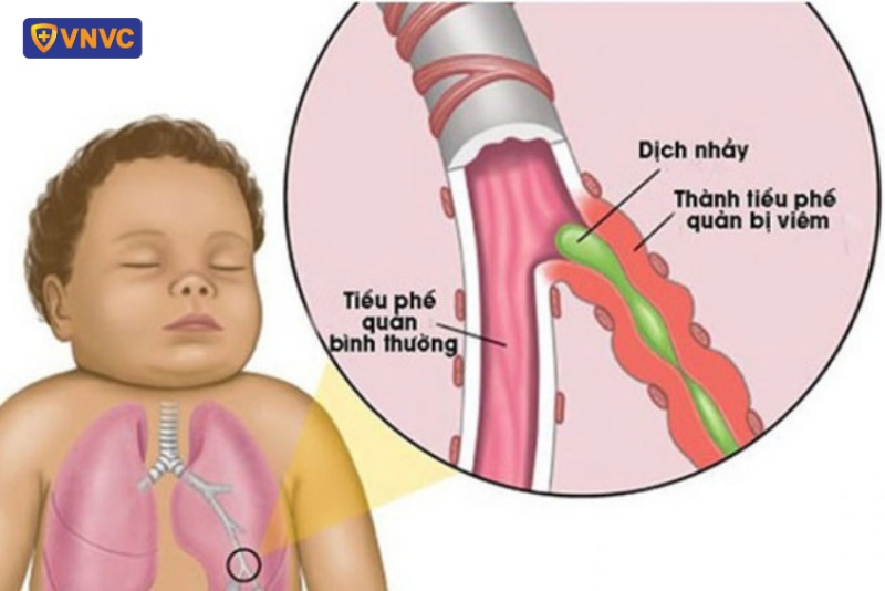 Viêm tiểu phế quản