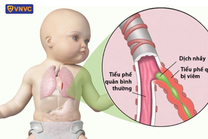Viêm tiểu phế quản bội nhiễm ở trẻ sơ sinh là gì