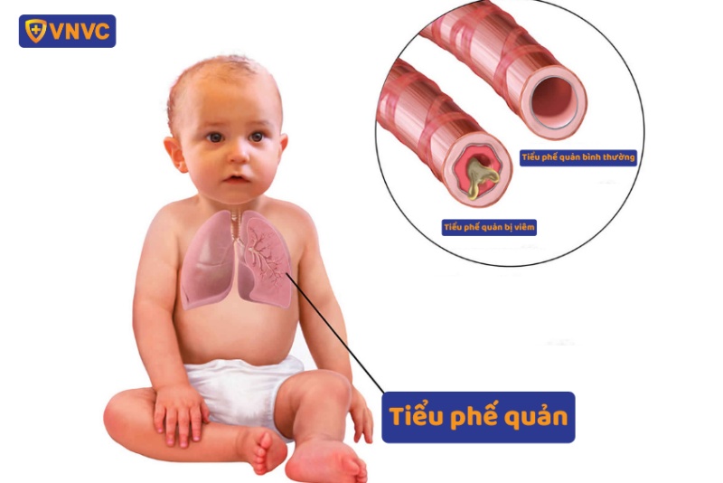 Viêm tiểu phế quản gây ra tình trạng sưng ở tiểu phế quản