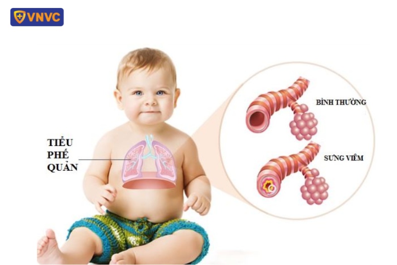 Viêm tiểu phế quản