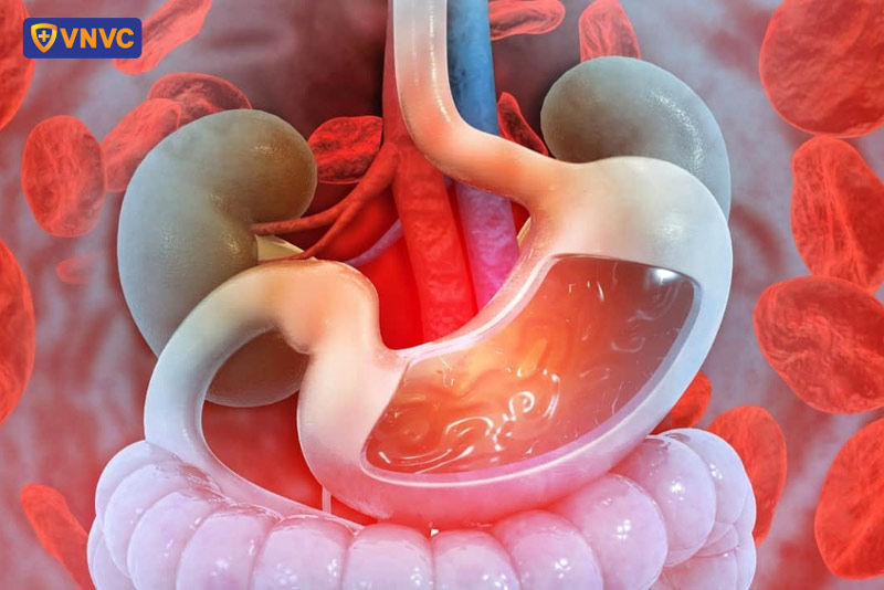 xuất huyết đường tiêu hóa do sốt xuất huyết