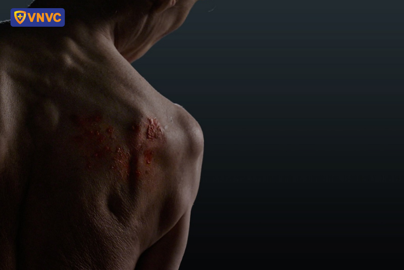 zona thần kinh ở vai