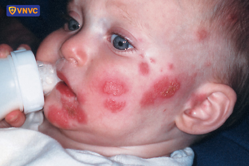 bệnh zona thần kinh ở trẻ sơ sinh