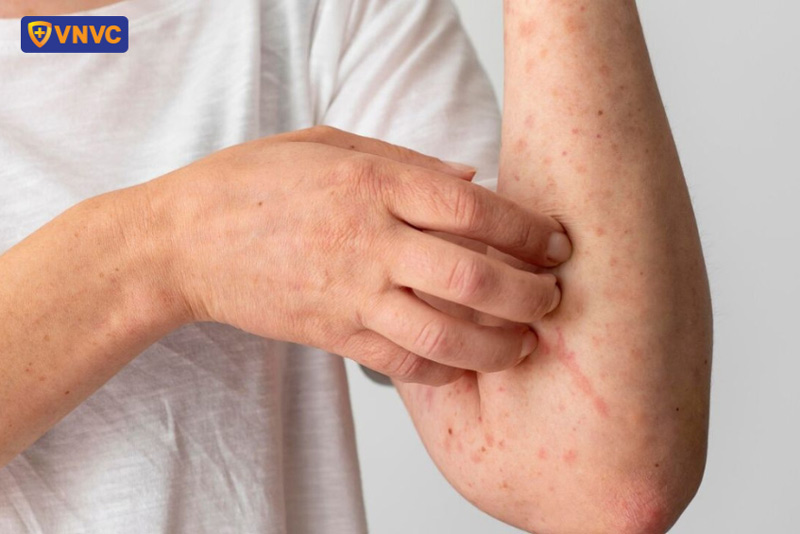 bị ngứa sau khi bị zona thần kinh