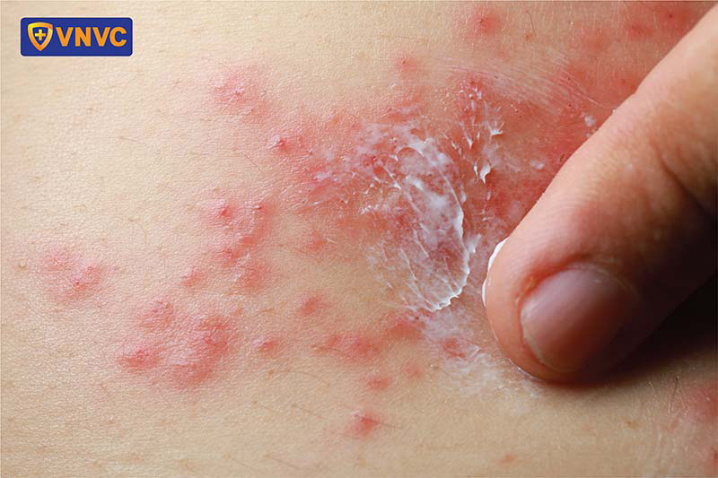 bôi thuốc trị zona thần kinh