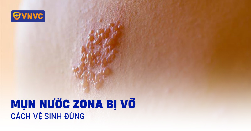 cách vệ sinh mụn nước zona bị vỡ