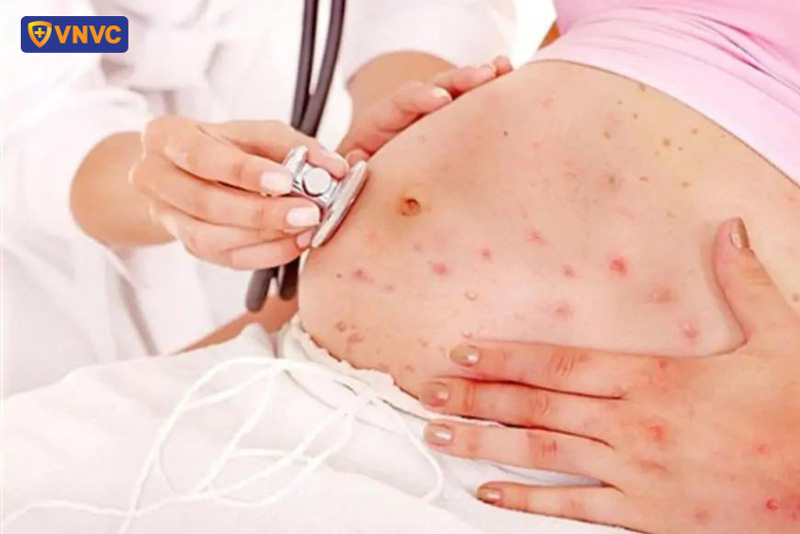 mẹ bầu bị thủy đậu