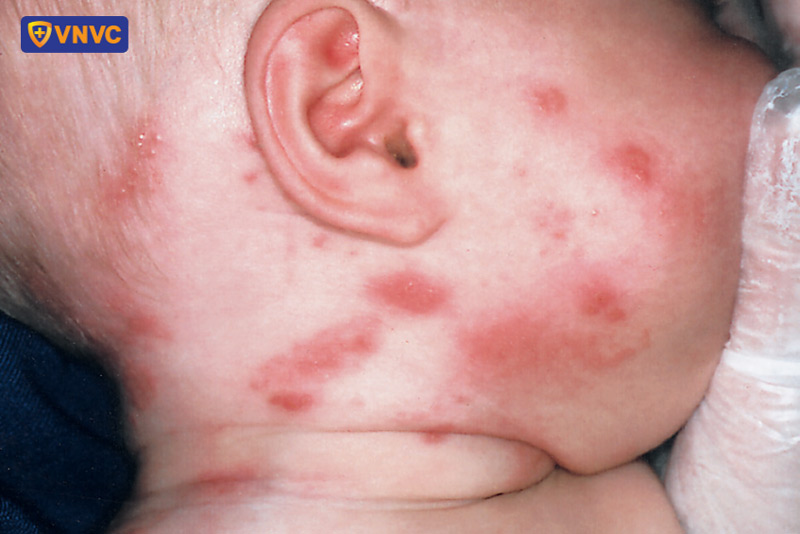trẻ sơ sinh bị zona thần kinh