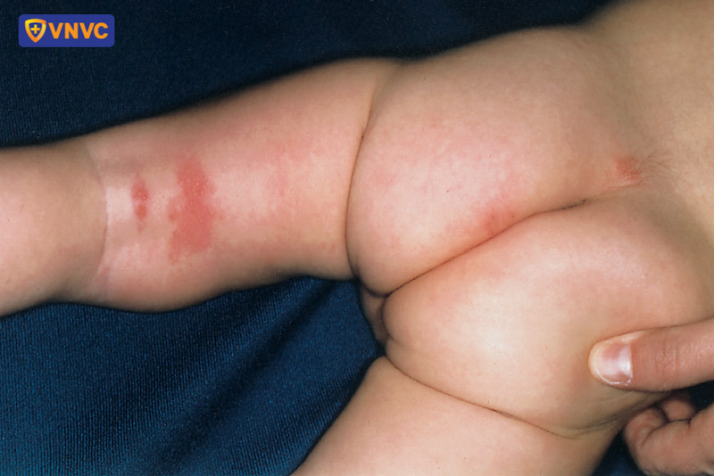 trẻ sơ sinh mắc zona thần kinh