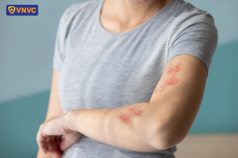 vết mụn nước zona bị vỡ