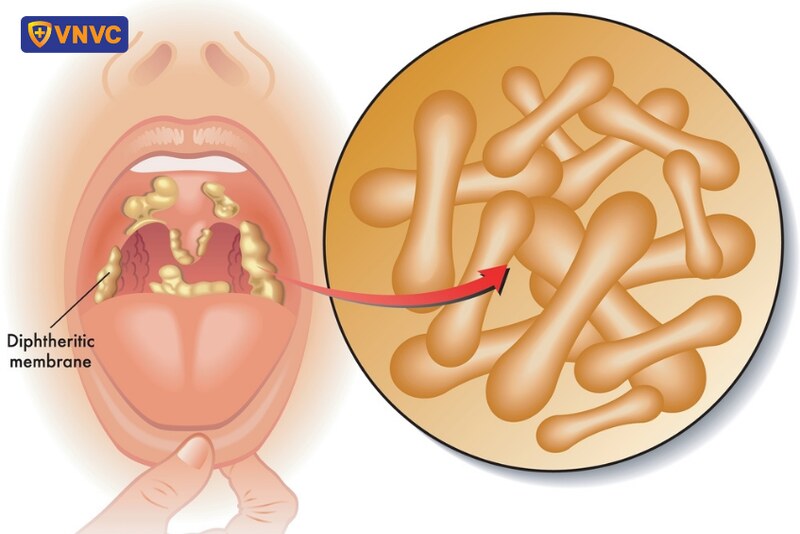 vi khuẩn bạch hầu gây ra các giả mạc