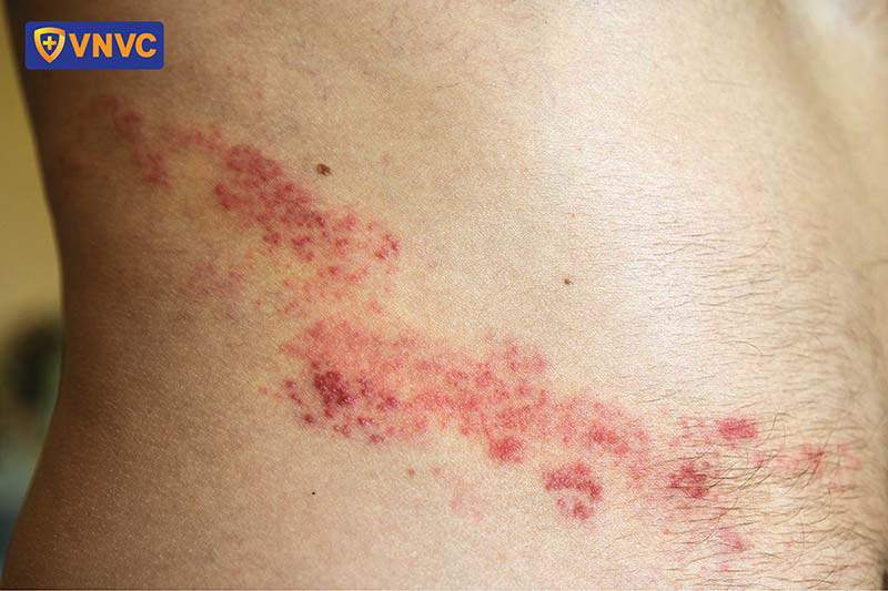 zona-than-kinh-bao-nhieu-ngay-thi-khoi