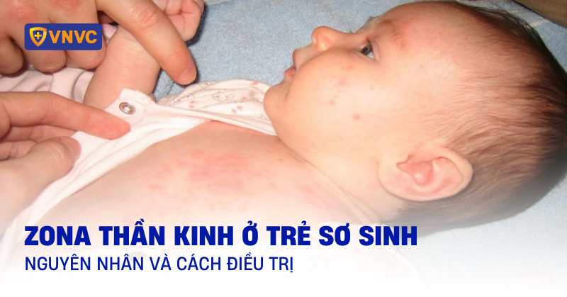 zona thần kinh ở trẻ sơ sinh