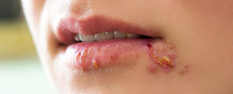 bệnh herpes giai đoạn cấp tính