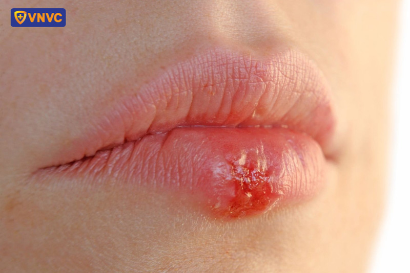 bệnh herpes