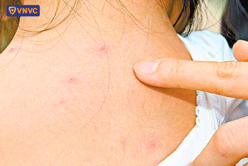 bệnh thủy đậu giai đoạn 3