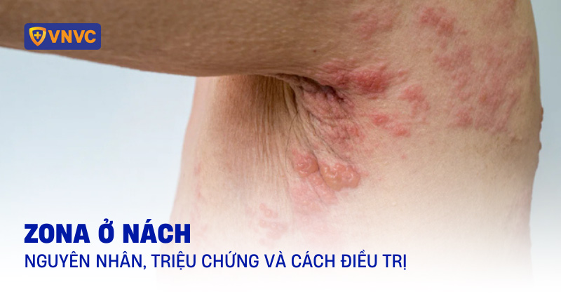 bệnh zona ở nách