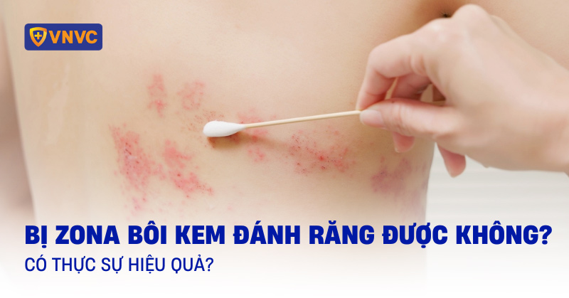 Bị zona bôi kem đánh răng được không? Có thực sự hiệu quả?