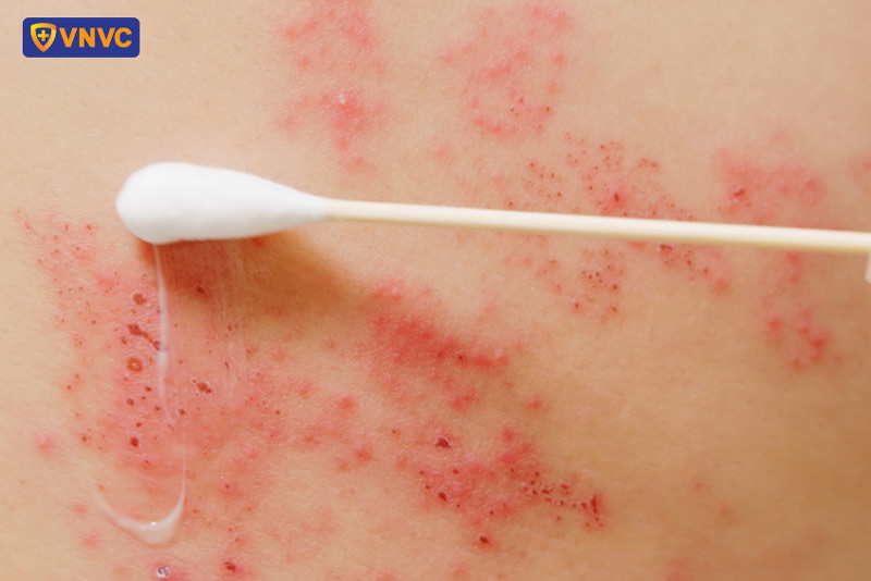 bị zona có bôi kem đánh răng được không