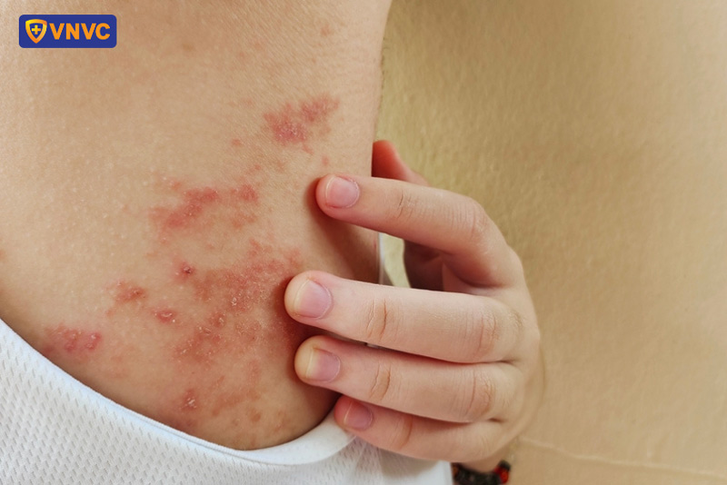 bị zona ở nách