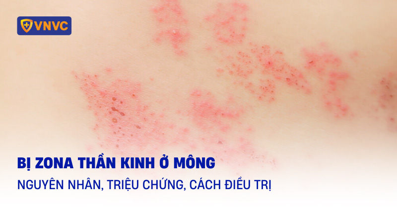 bị zona thần kinh ở mông