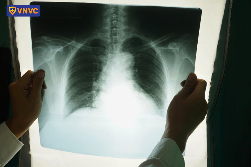 chụp x quang phổi