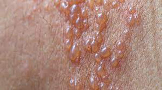 dải mụn nước zona