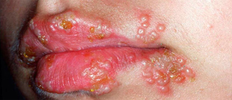 herpes giai đoạn cấp tính