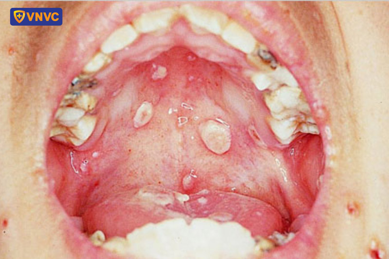 hình ảnh bệnh thủy đậu giai đoạn 3
