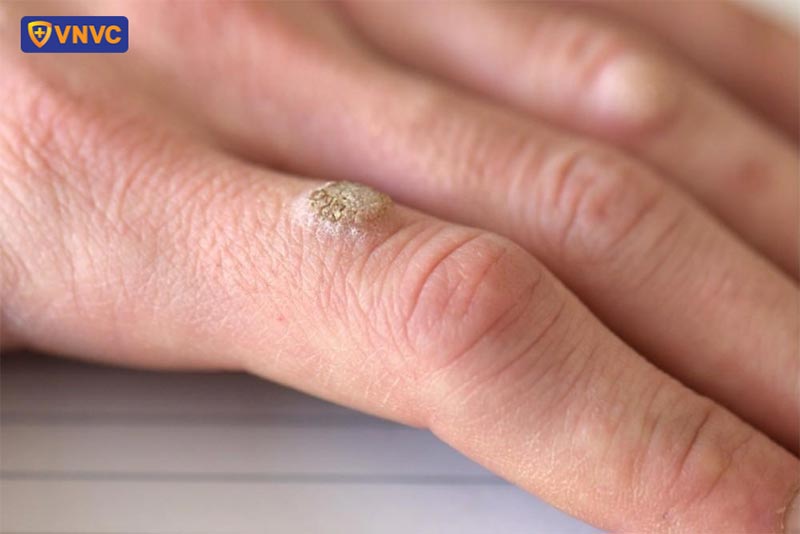 mụn cóc có đường kính khoảng 2 - 10 milimet