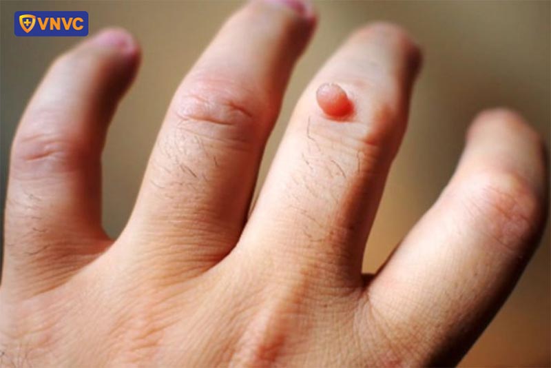 mụn cóc của người bán thịt