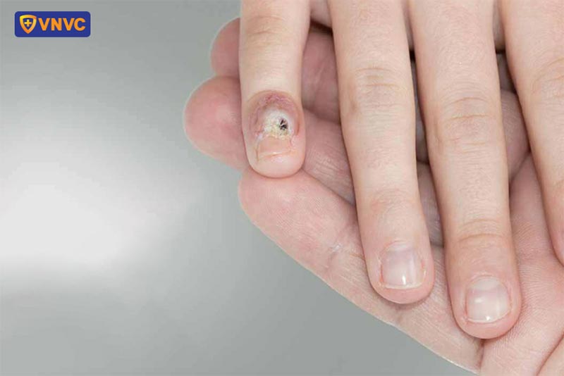 mụn cóc là những khối u lành tính