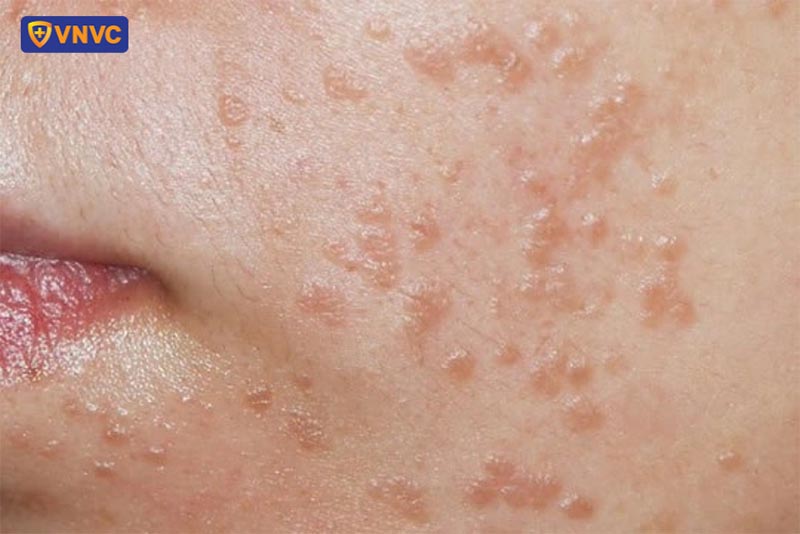 mụn cóc phẳng