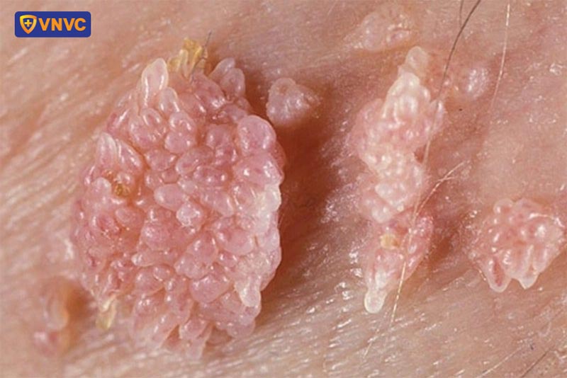 mụn cóc sinh dục