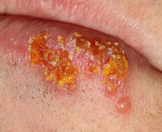 mụn nước do herpes khô, đóng vảy