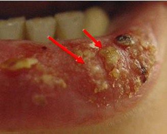 mụn nước do herpes