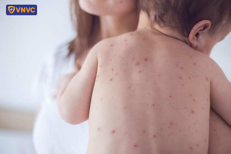 mụn nước thủy đậu trên lưng bé